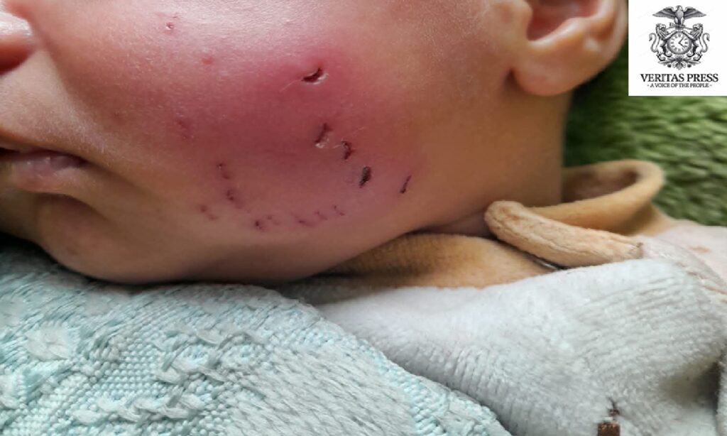 GAZA: Rat Bite Leaves Newborn Injured In Gaza As Siege Conditions Push Civilians To The Brink.